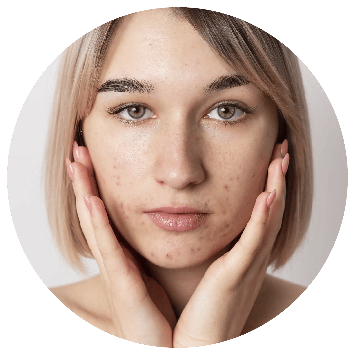 Active Acne treatment results at Toronto medical spa - The Chain Reaction of Symptoms